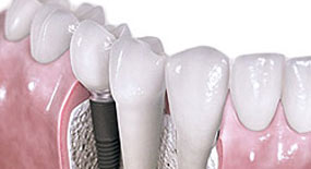 İmplant tedavisinde 'yalancı kist' uyarısı