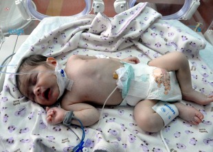 10 günlük bebeğe stent takıldı