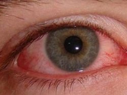 Kırmızı göz kabusu dönebilir