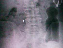 Makatından pet şişe girince...