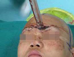 Samuray kılıcı başına saplandı