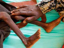 Somali'deki acı tablo korkutuyor