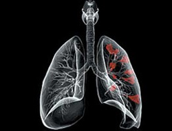 Bu bitki akciğer hastalığına iyi geliyor