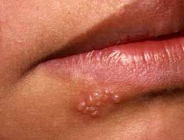 ''Uçuktur, geçer'' deyip geçmeyin!