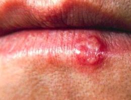 Uçuk sandığınızdan daha tehlikel!