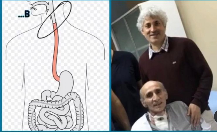 Bağırsağından ve cilt dokusundan yemek borusu yapıldı