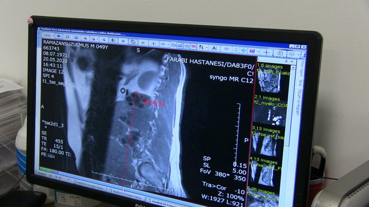 Konya'da köpekten insana bulaşan kist tedavi edildi!