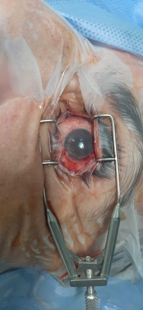 Konya'da doğum zarından alınan kök hücreyle göz tedavisi yapıldı