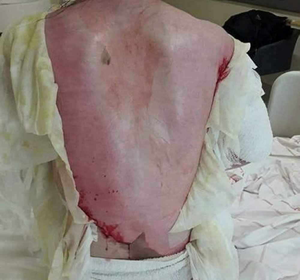 Eşi tarafından feci şekilde haşlanan Rukiye yalvardı: Ölmek istemiyorum