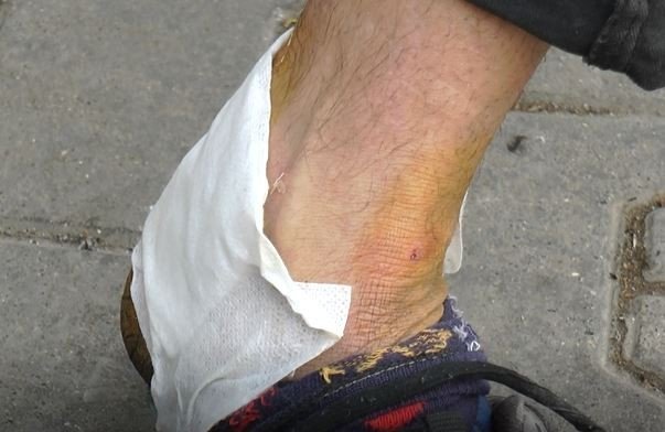 Gaziantep’te bir pitbull vakası daha! Tartıştığı adamın üstüne köpeğini saldı