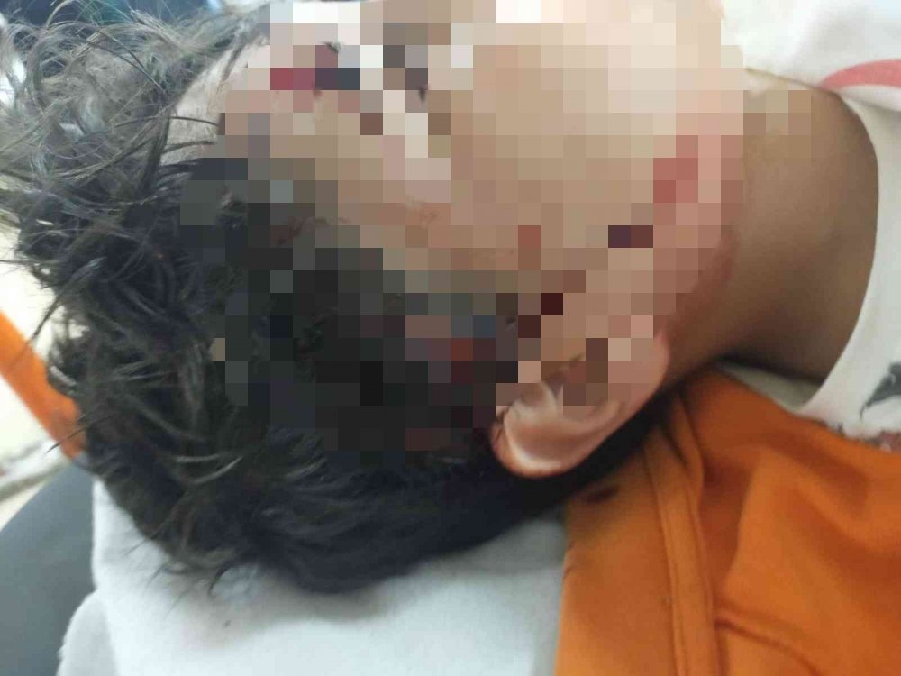 Bursa'da okula giden 10 yaşındaki çocuğa başıboş 8 köpek saldırdı, 80 dikiş atıldı