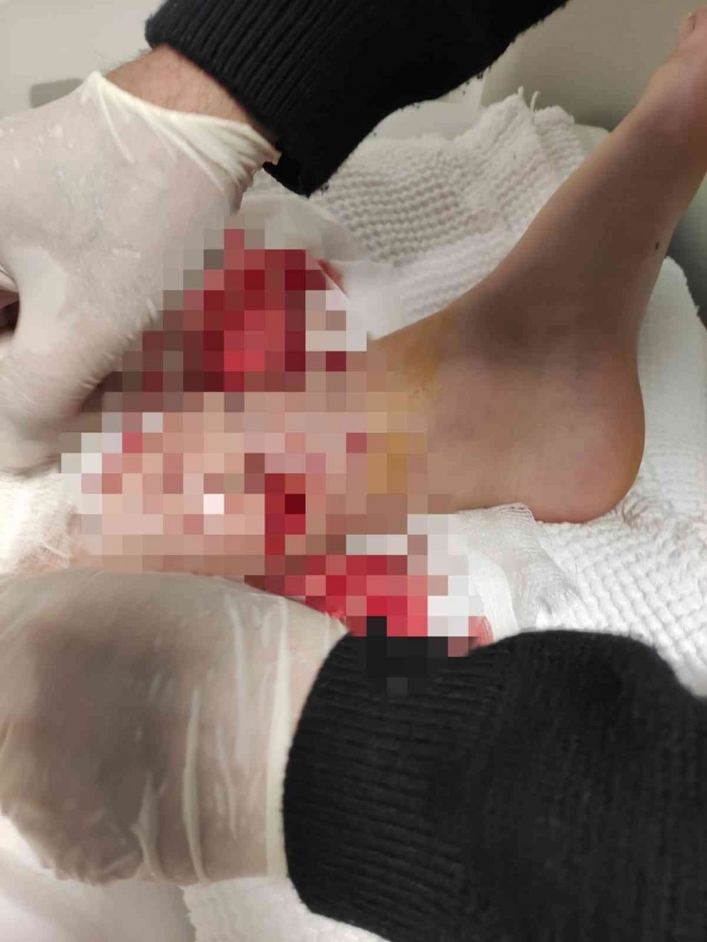 Bursa'da okula giden 10 yaşındaki çocuğa başıboş 8 köpek saldırdı, 80 dikiş atıldı