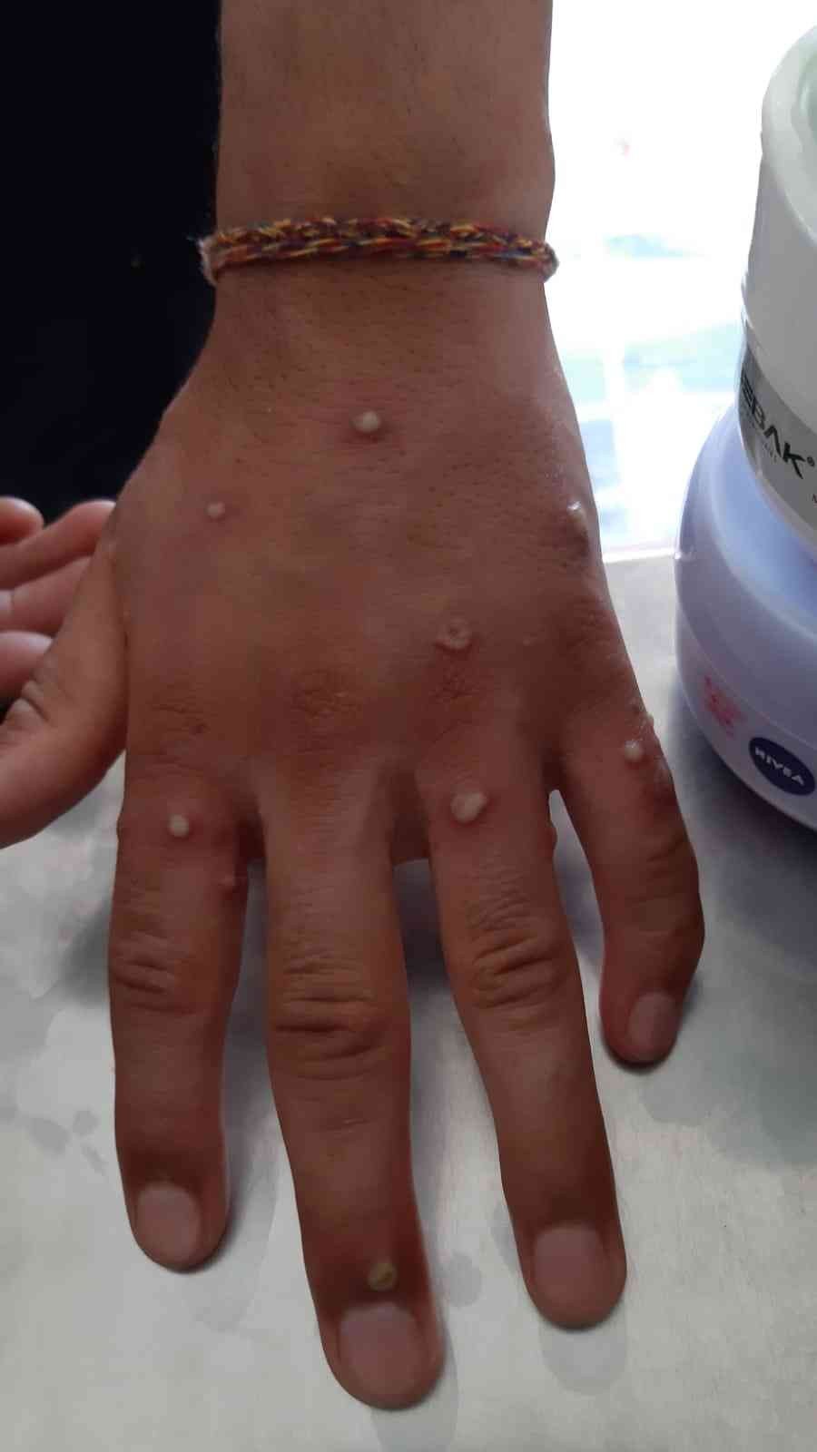 İstanbul'da 'maymun çiçeği' iddiası! Eczaneye gitti karantinaya alındı