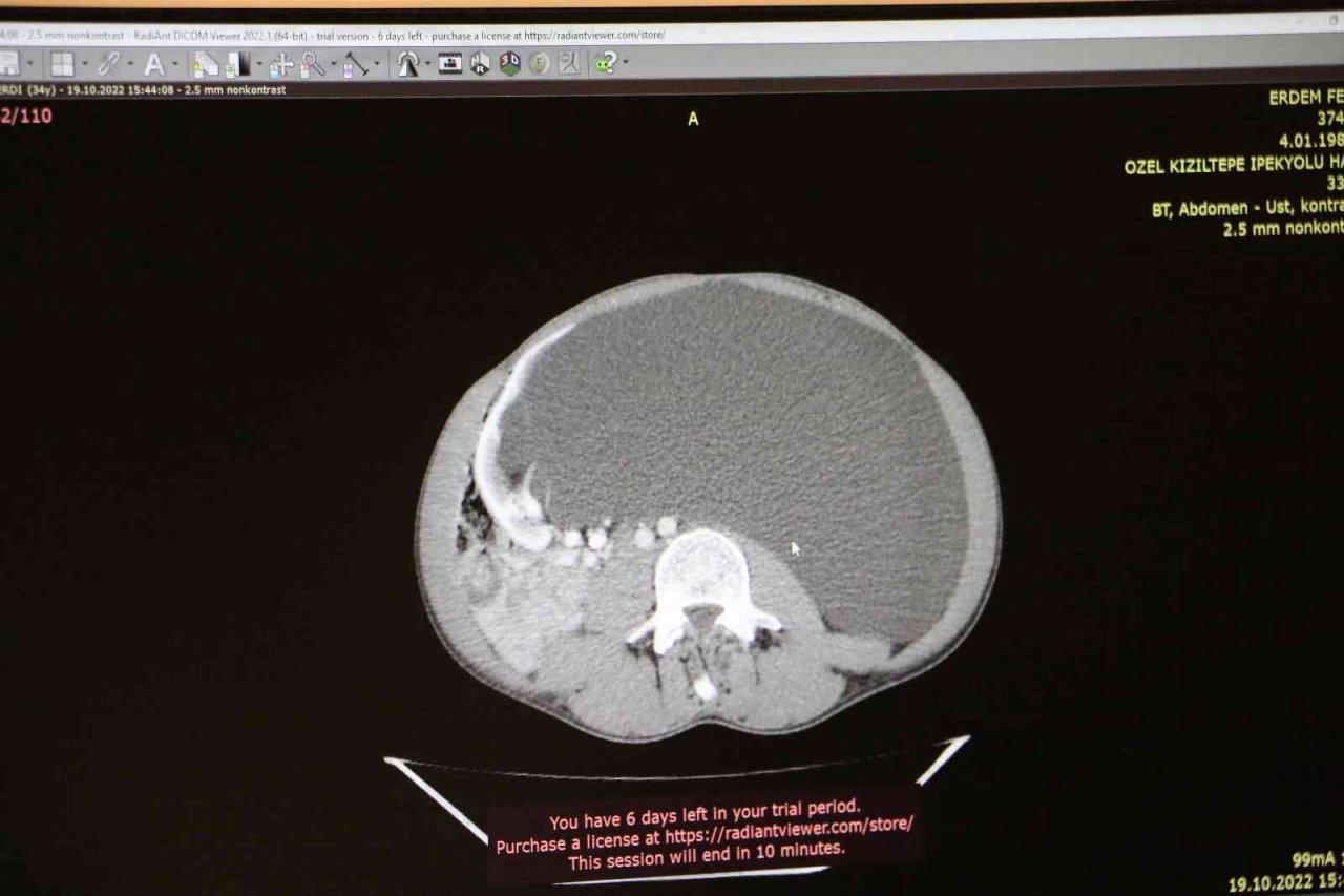 Mide şikayeti üzerine hastaneye gitti, böbreğinde 60 santim kist çıktı