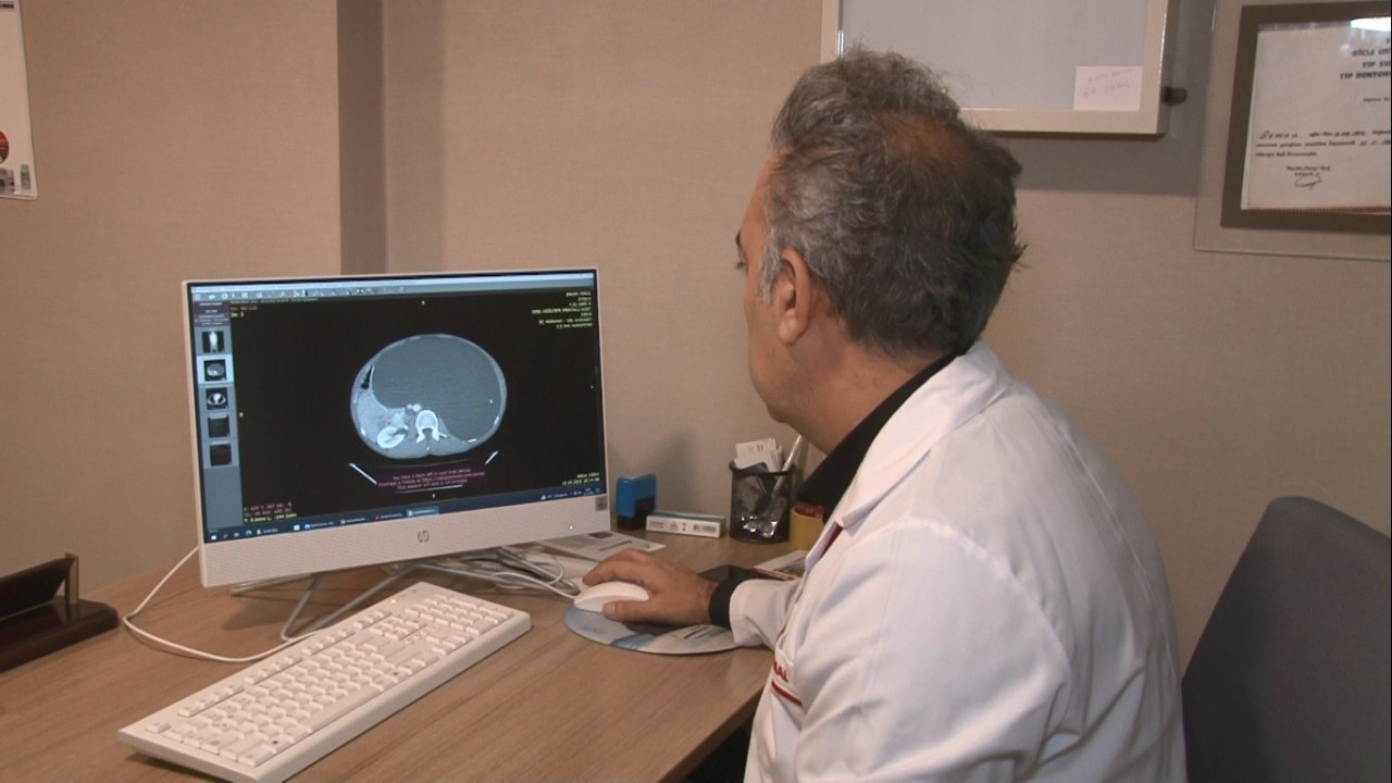 Mide şikayeti üzerine hastaneye gitti, böbreğinde 60 santim kist çıktı