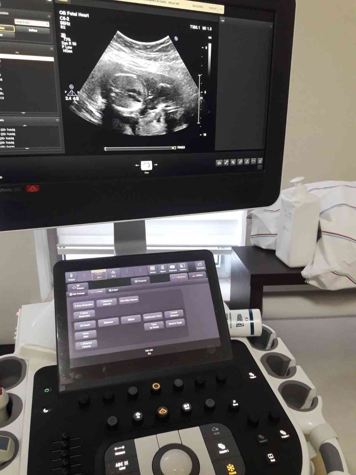 Karaman Eğitim ve Araştırma Hastanesinde fetal ekokardiyografi görüntüleme işlemi başladı