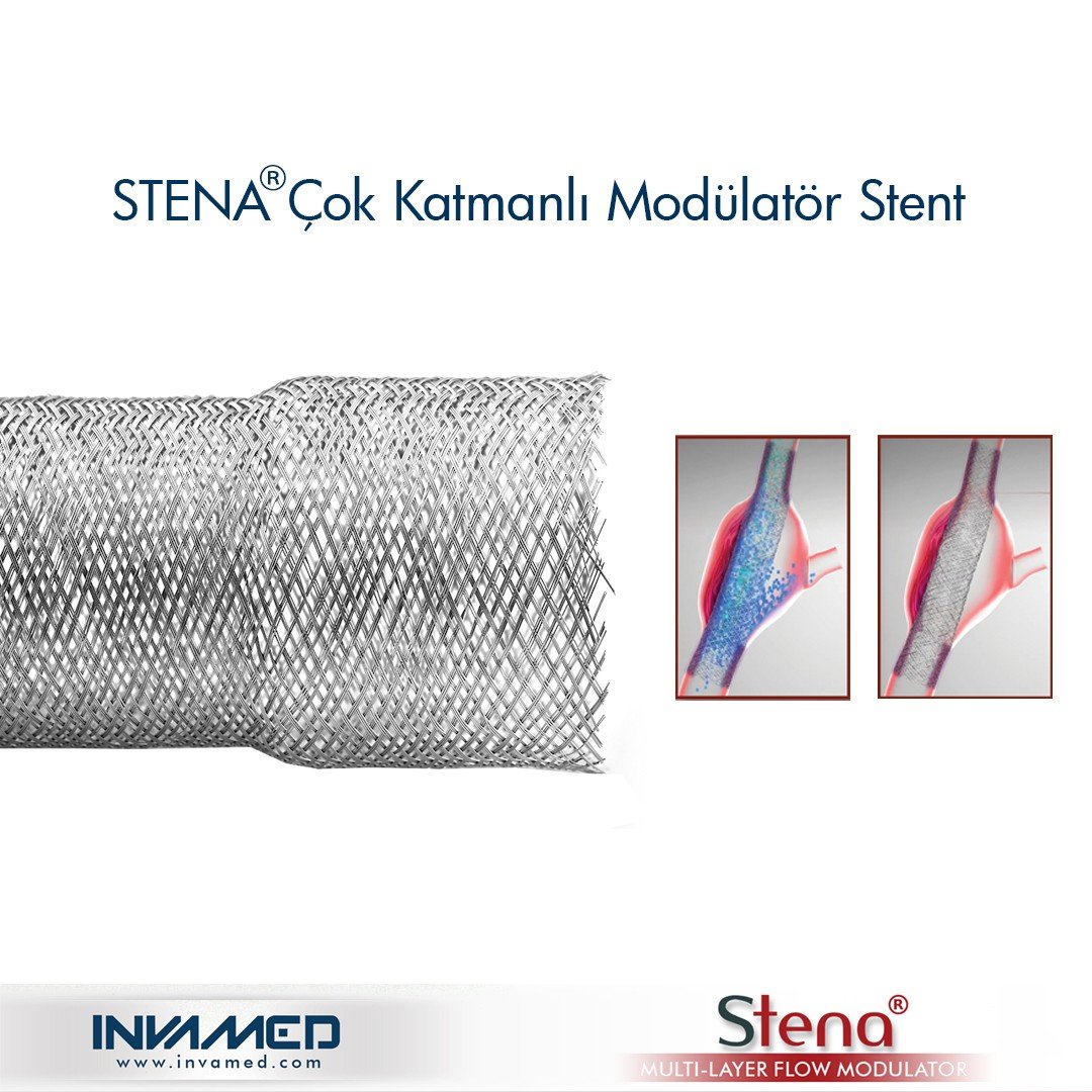 Aort anevrizmasına STENA stent tedavisi