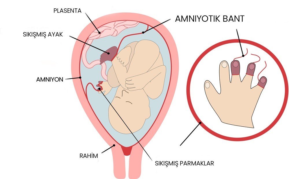 Amniyotik bant sendromu olan bebekler anne karnında ameliyat ile tedavi edilebiliyor