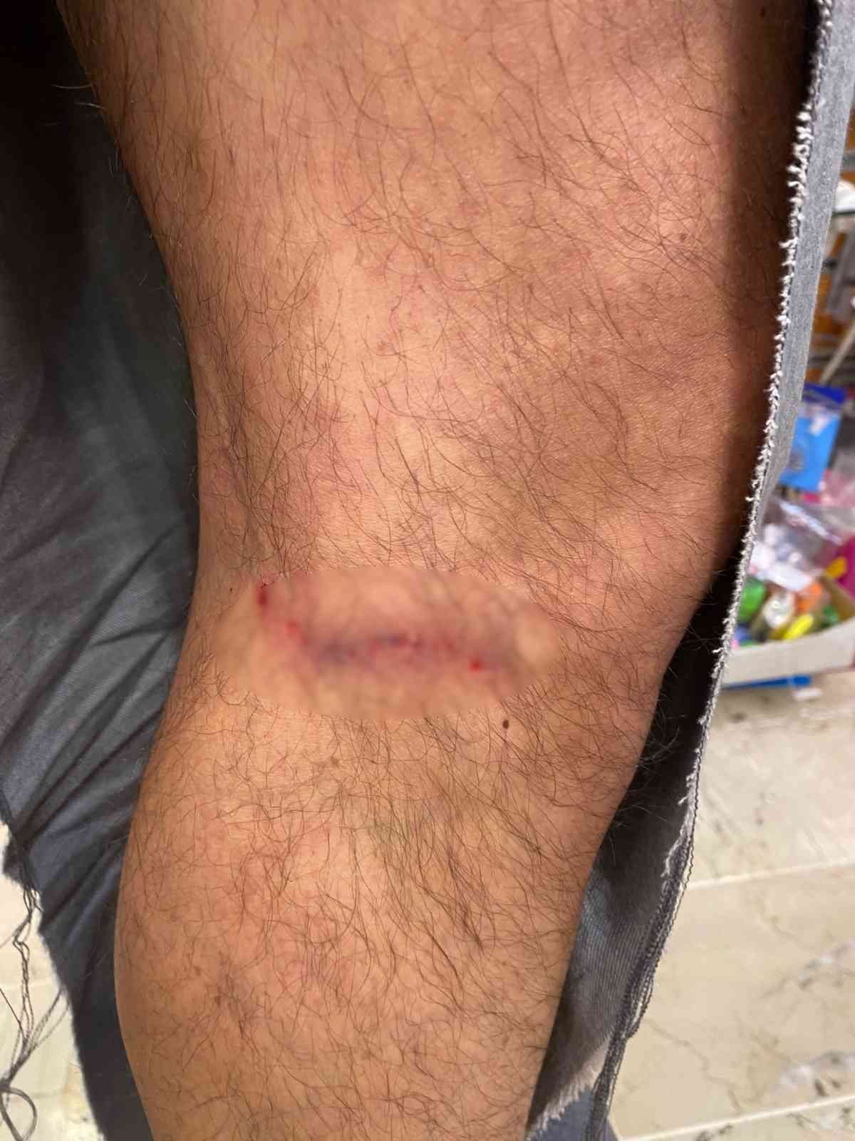 Çankaya’da başıboş köpekler vatandaşın kıyafetlerini parçaladı