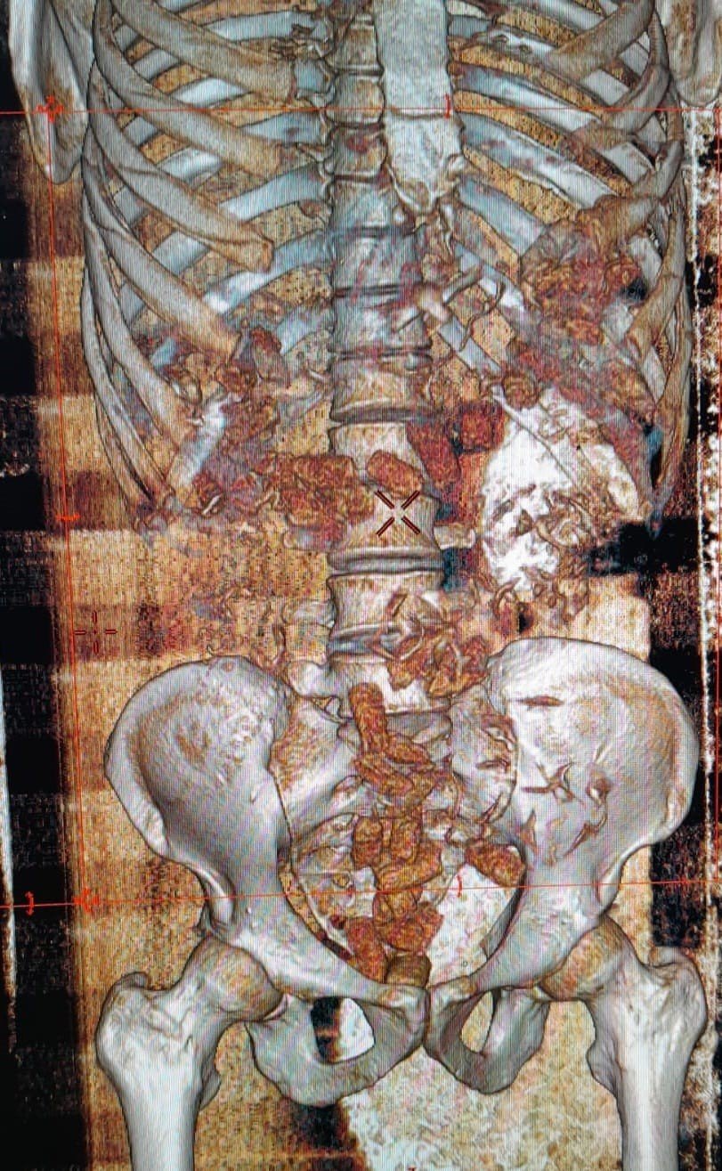 Uyuşturucu maddeyi bağırsaklarında saklamışlar