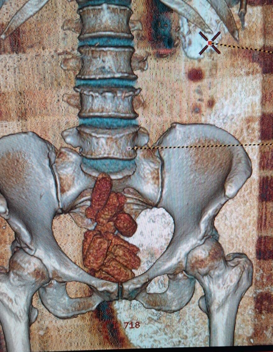 Uyuşturucu maddeyi bağırsaklarında saklamışlar