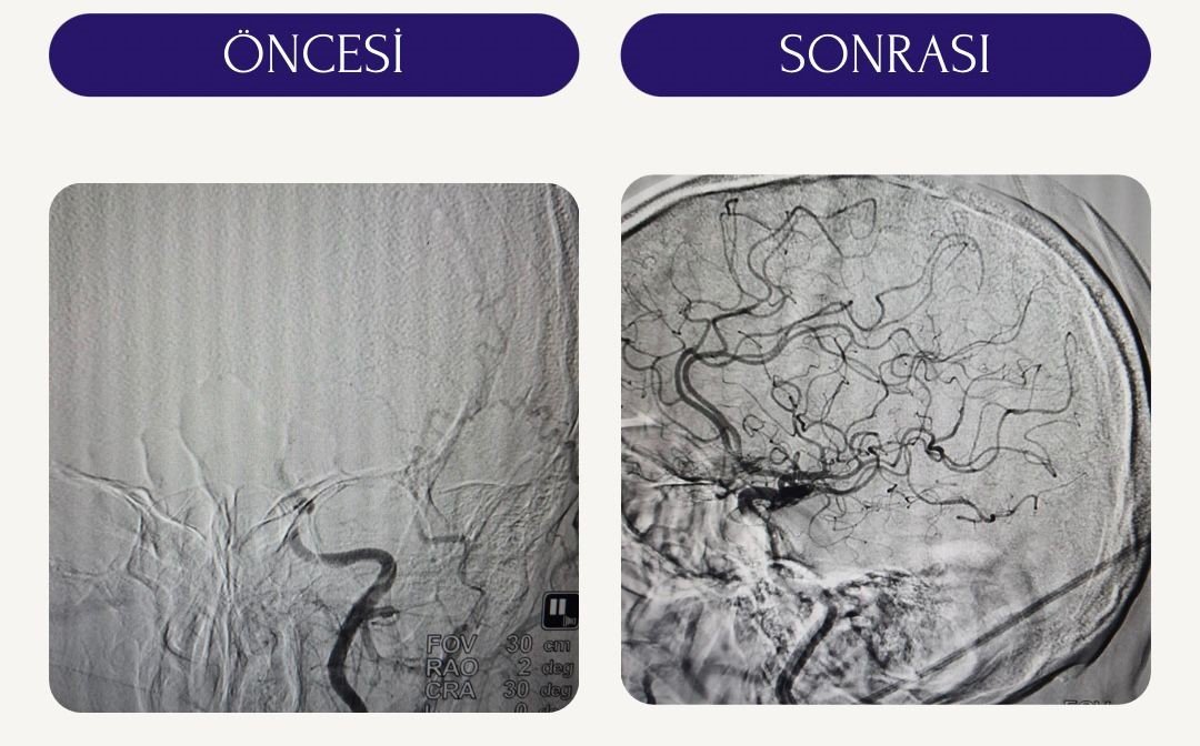 İnme geçiren hastalara Trombektomi tedavisi
