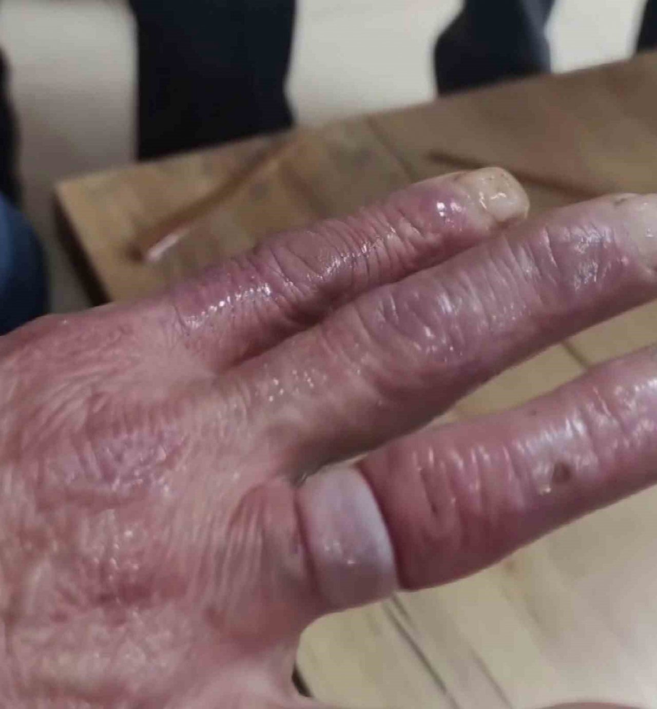 Yüzük parmağına sıkıştı, imdadına itfaiye koştu