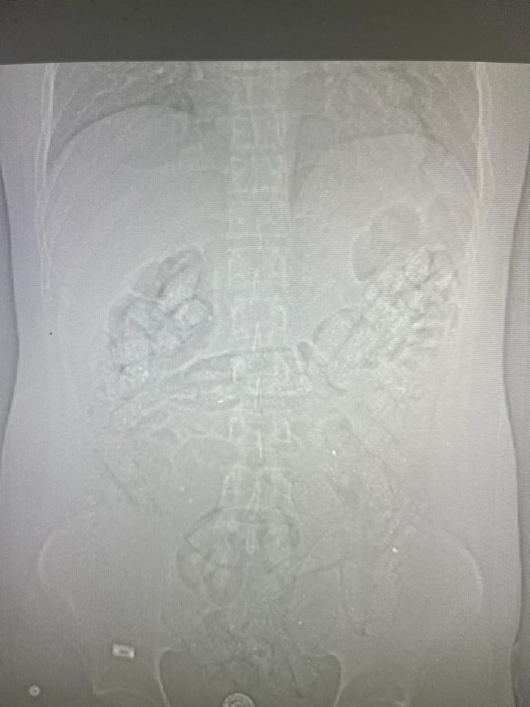 Midesinde uyuşturucu sevkiyatı yapan zanlı tutuklandı
