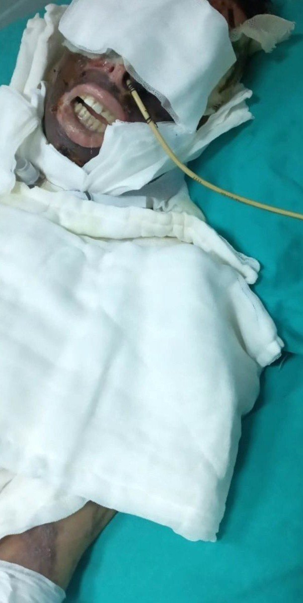 Kimyasalla yaktığı kadını yatağa mahkum eden sanığın yargılanmasına devam edildi