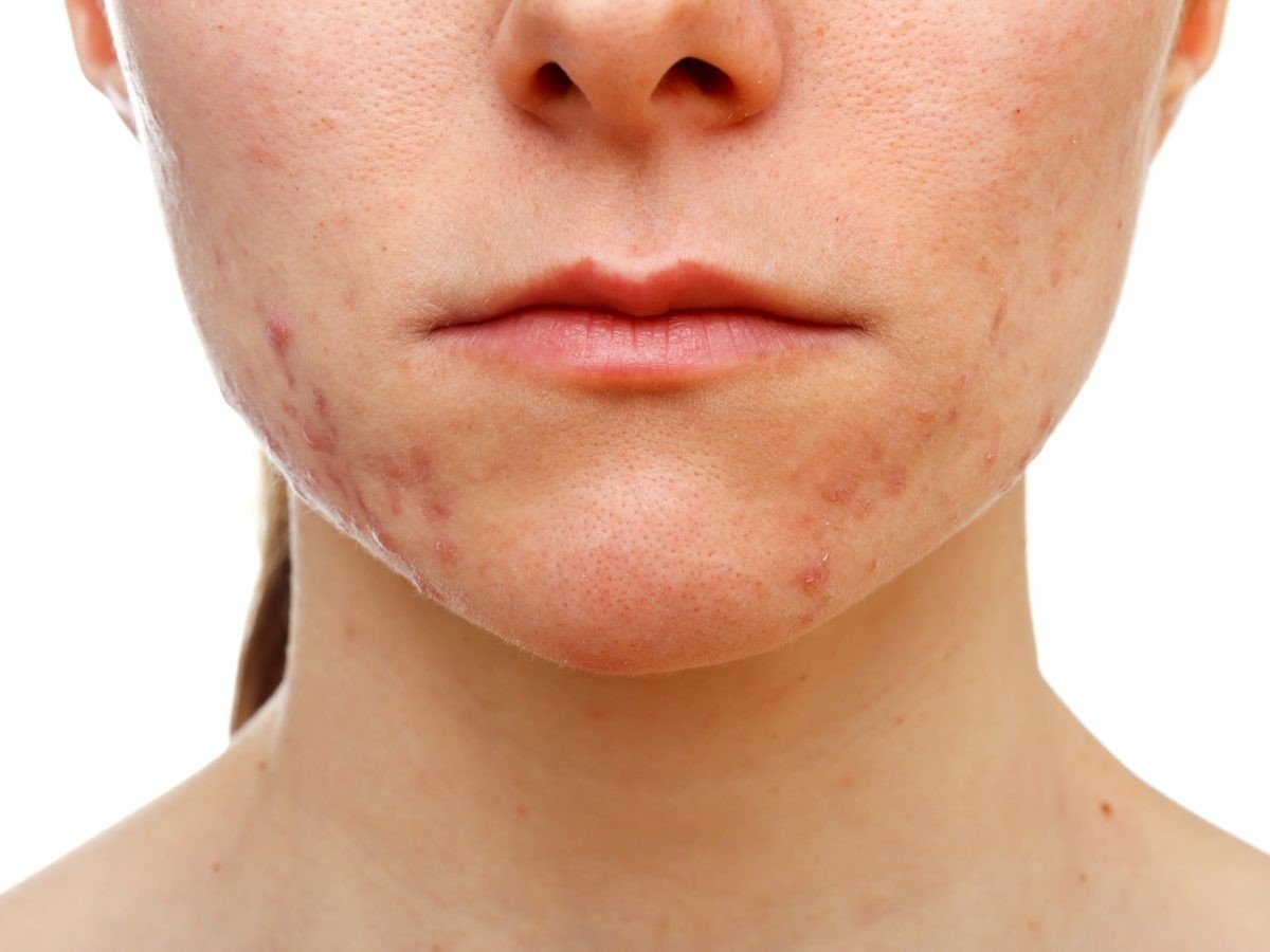 2030 yılında toplumun yüzde 50’si alerjik hasta olabilir