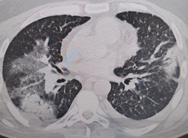 Klimaya bağlı “yaz zatürresine” dikkat