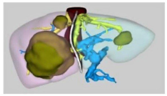Güney Kore’den şifa için SANKO Üniversitesi Hastanesi’ne geldi
