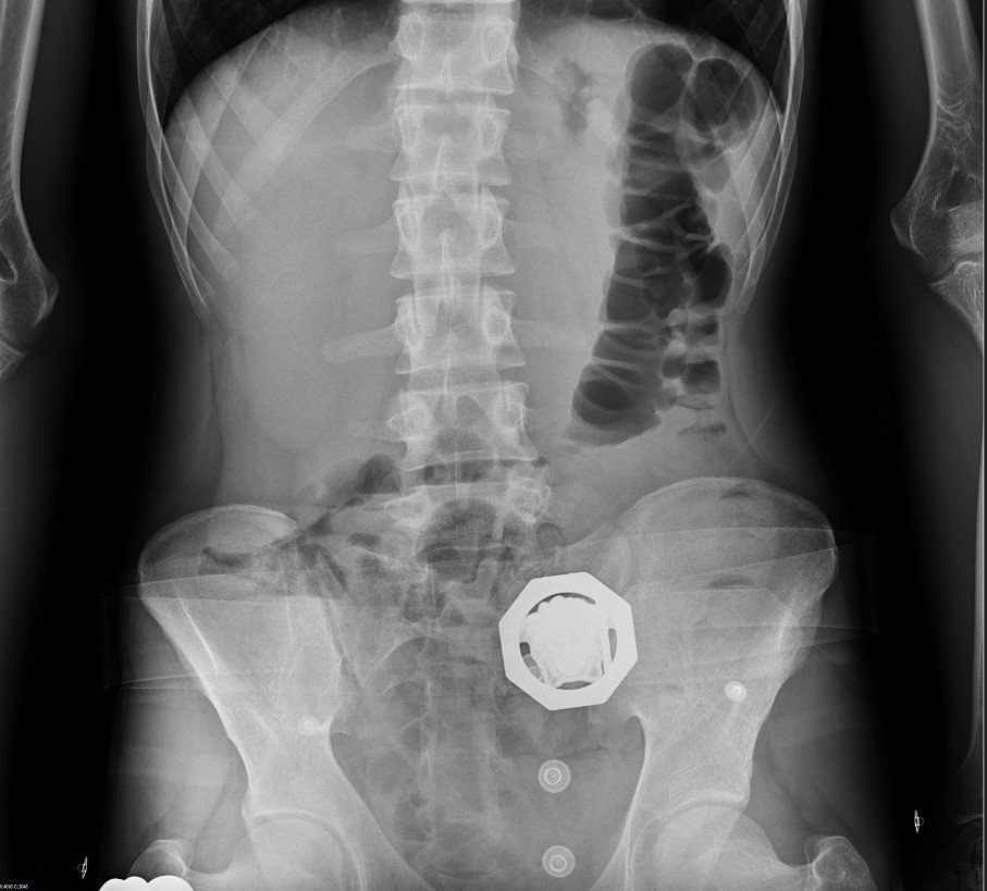 Diyarbakır’da 4 kişinin sindirim sisteminden 840 gram eroin ele geçirildi: 4 kişi tutuklandı