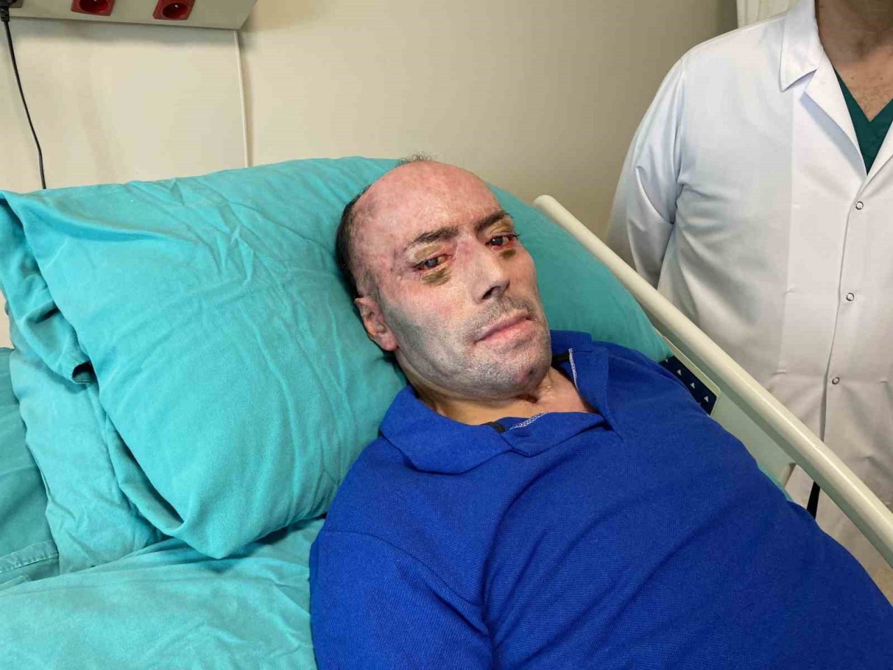 140 ameliyat geçiren 8 ayı aşkın süre hastanede kalan maden işçisi İzzet Ak taburcu edildi