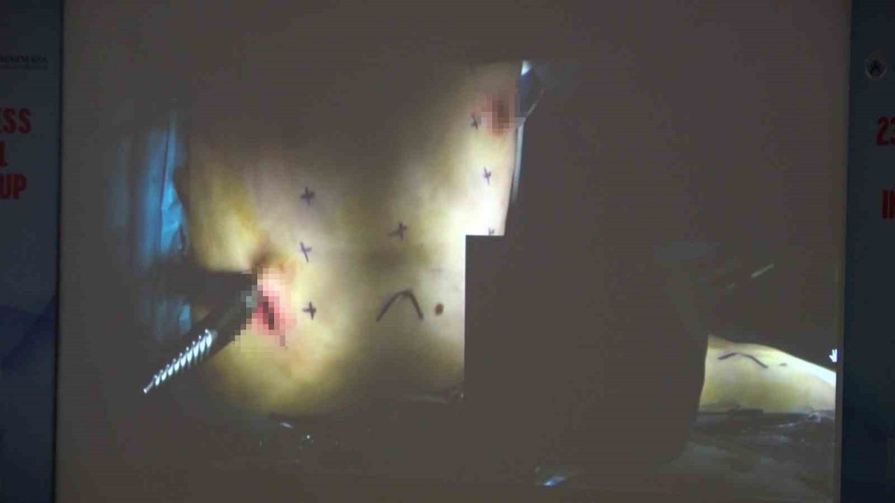 Yurtdışından gelen hekimler, İstanbul’da Pektus kongresine katıldı