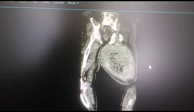 Ayakları ağrıdığı için hastaneye gitti, uyluk kemiğinden 8,9 kilo tümör çıktı