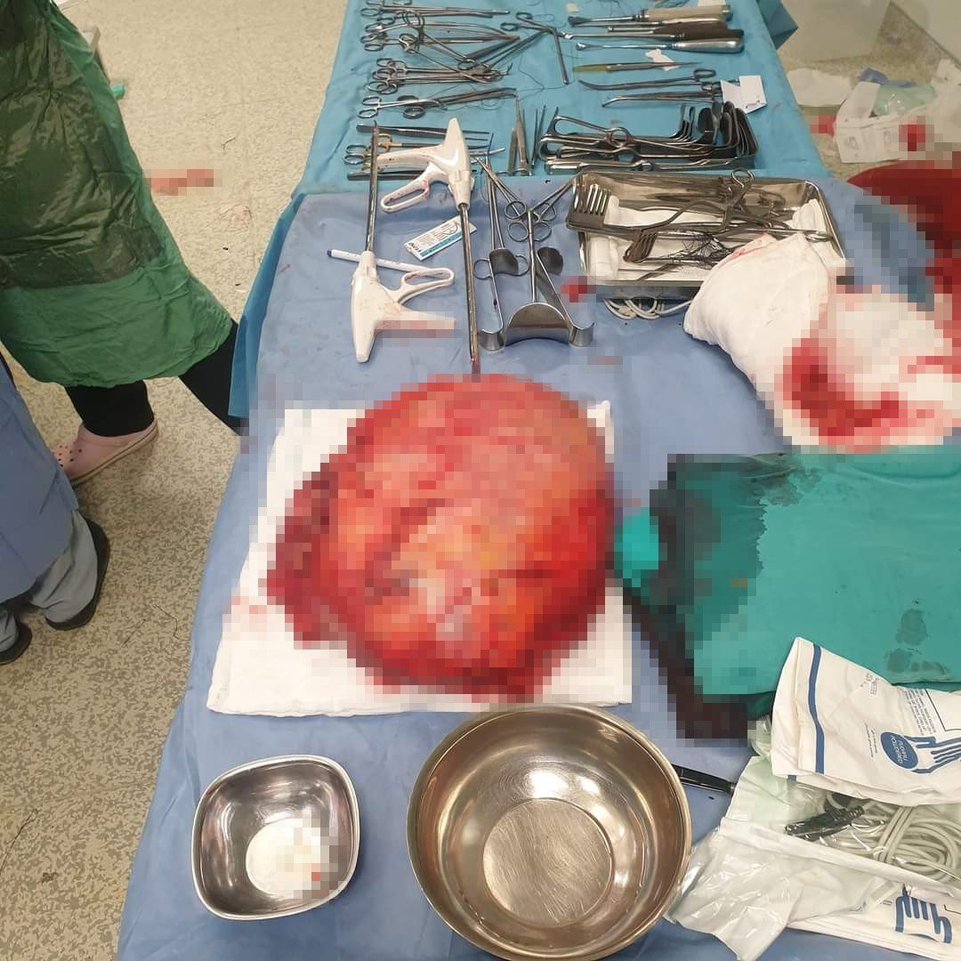 Ayakları ağrıdığı için hastaneye gitti, uyluk kemiğinden 8,9 kilo tümör çıktı