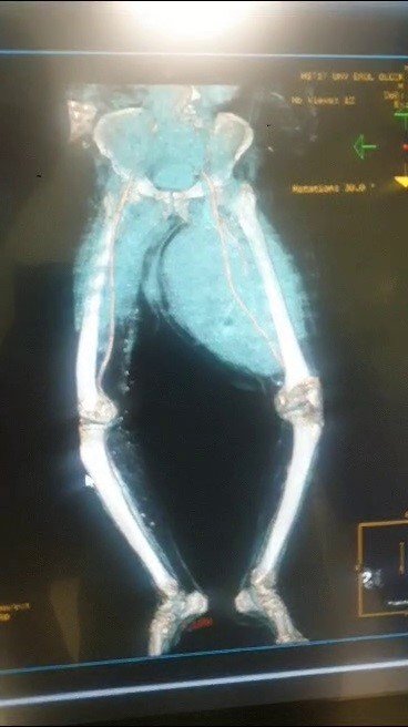 Ayakları ağrıdığı için hastaneye gitti, uyluk kemiğinden 8,9 kilo tümör çıktı