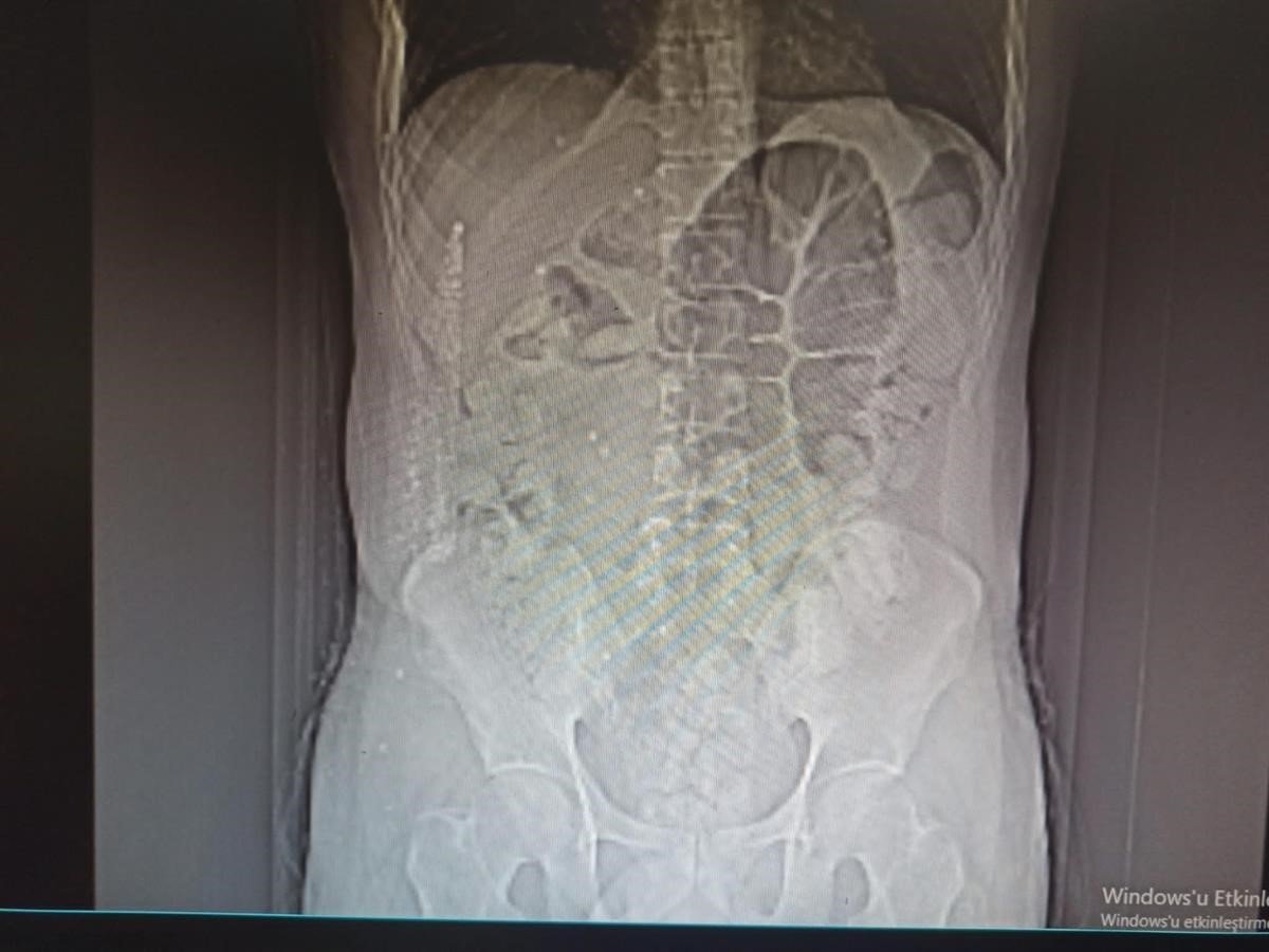 İranlı uyuşturucu kuryesinin midesinden 711 gram uyuşturucu çıktı