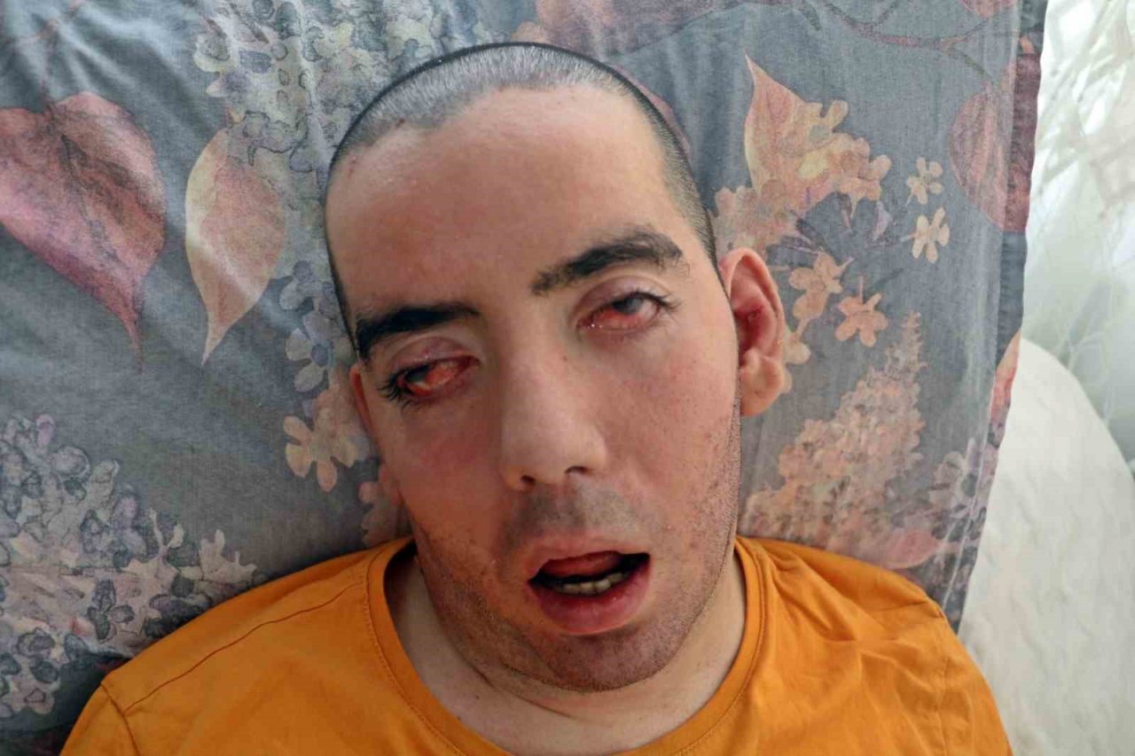 Doktorlar 6 ay ömür biçti, 10 yıldır gözlerini bir an olsun kırpmadan yaşam savaşı veriyor