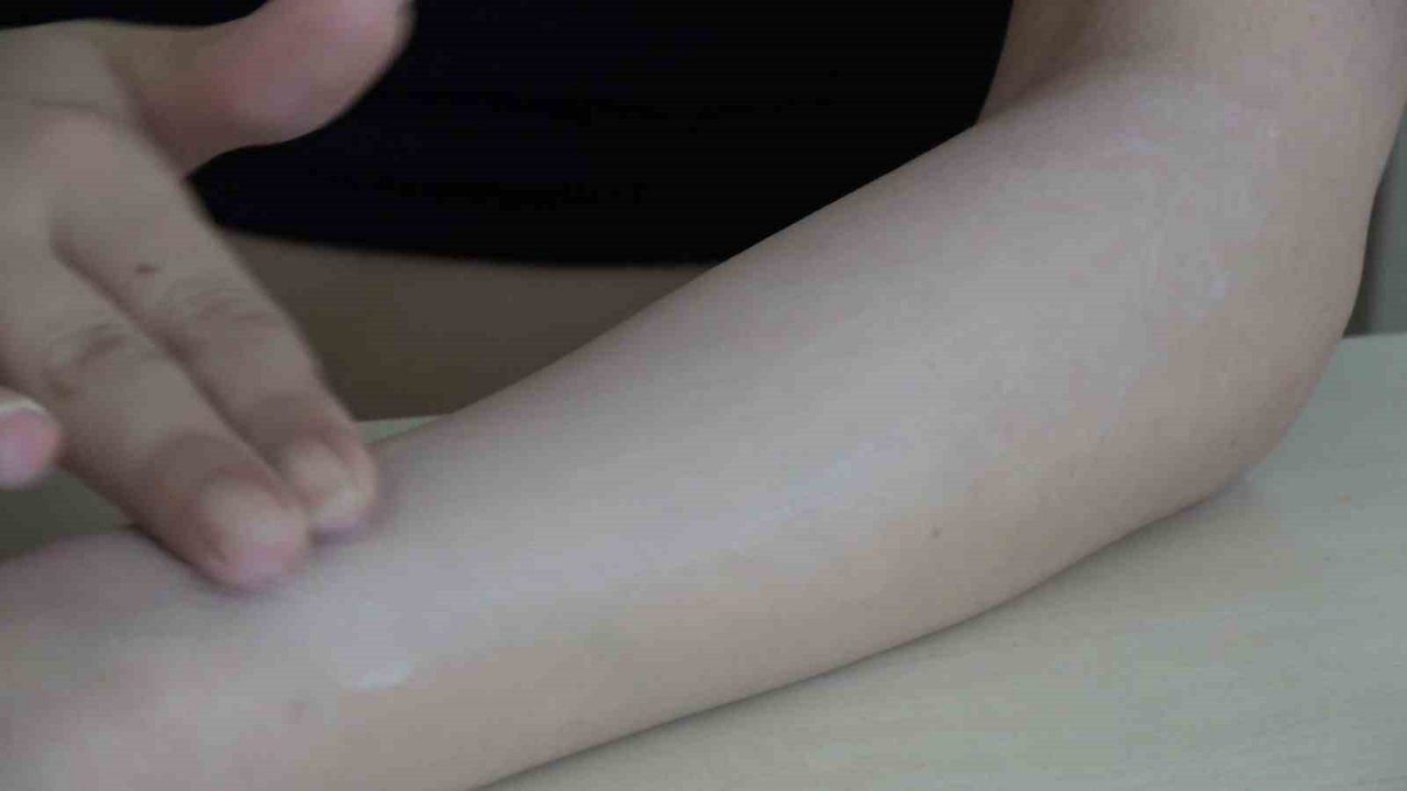 Uzmanı uyardı, güneş yanıklarına evde tedavi uygulanmamalı