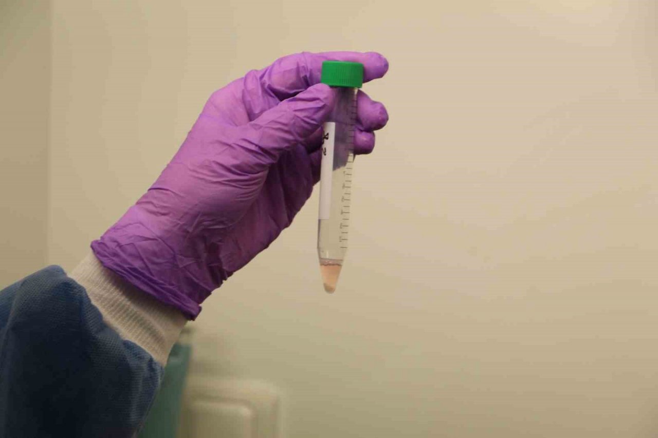 Türkiye’de sıkça görülen mesane kanserinde yeni tedavi yöntemi geliştiriliyor