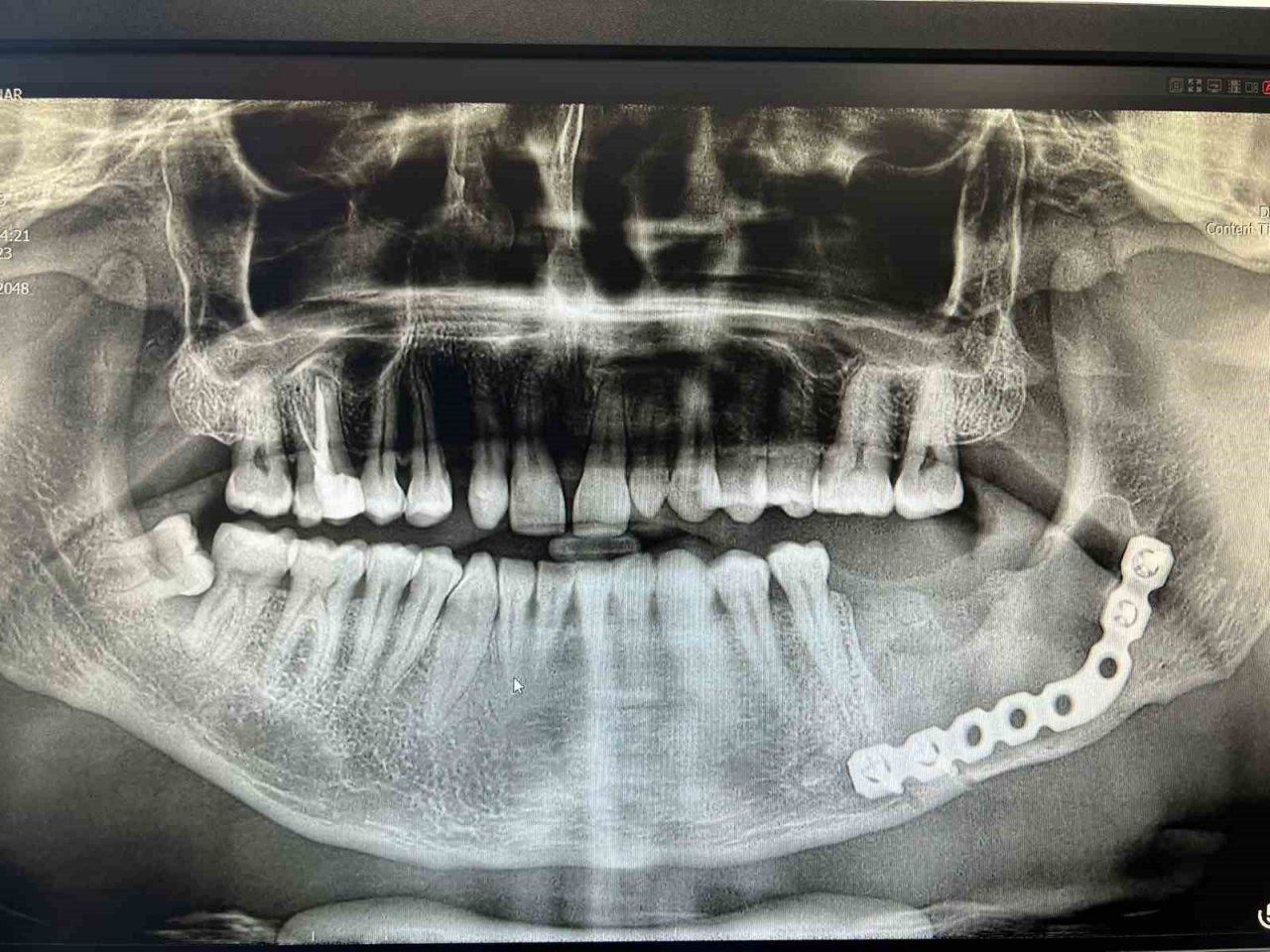 3D modelleme üzerinde test yapıldı, ardından hastaya uygulandı