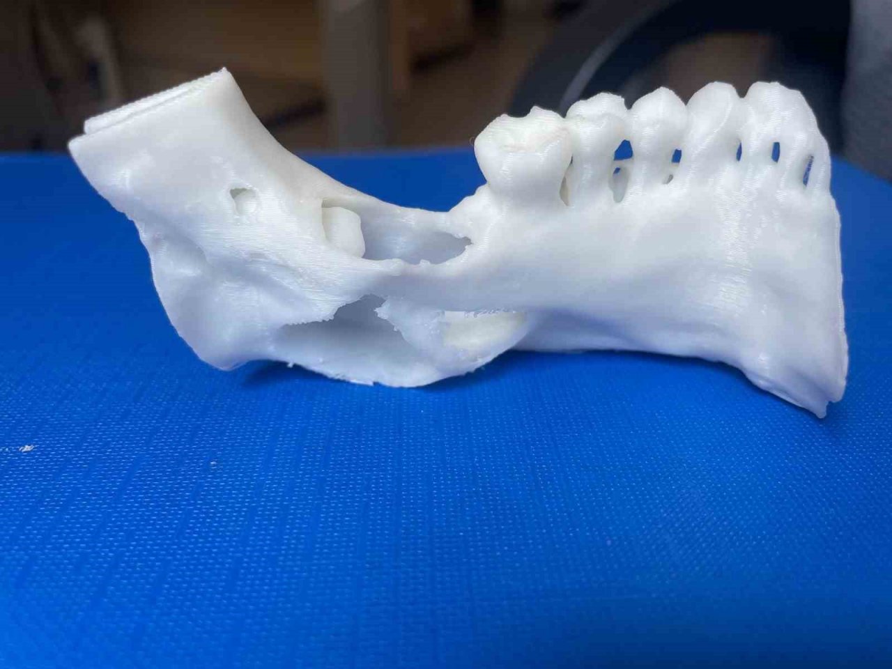 3D modelleme üzerinde test yapıldı, ardından hastaya uygulandı