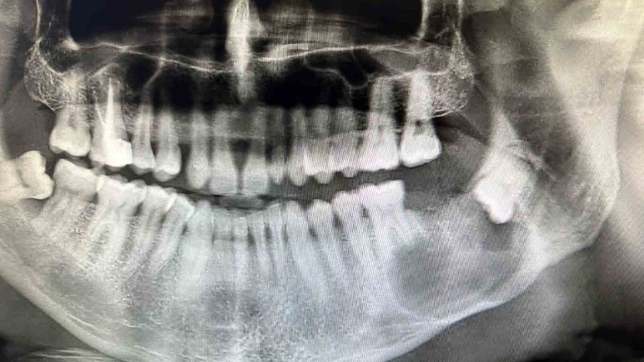 3D modelleme üzerinde test yapıldı, ardından hastaya uygulandı