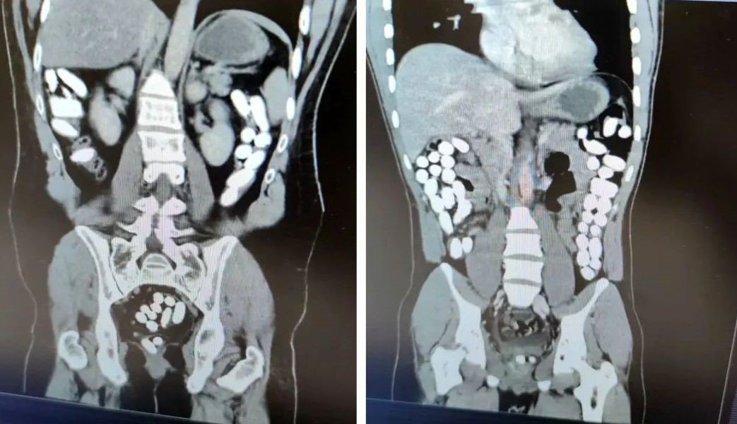 İranlı uyuşturucu kuryelerinin midesinden 2 kilo uyuşturucu çıktı