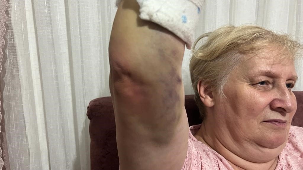 Bileği kırılan Ukraynalı kadından 44 bin 555 TL’lik alçı faturası itirazı