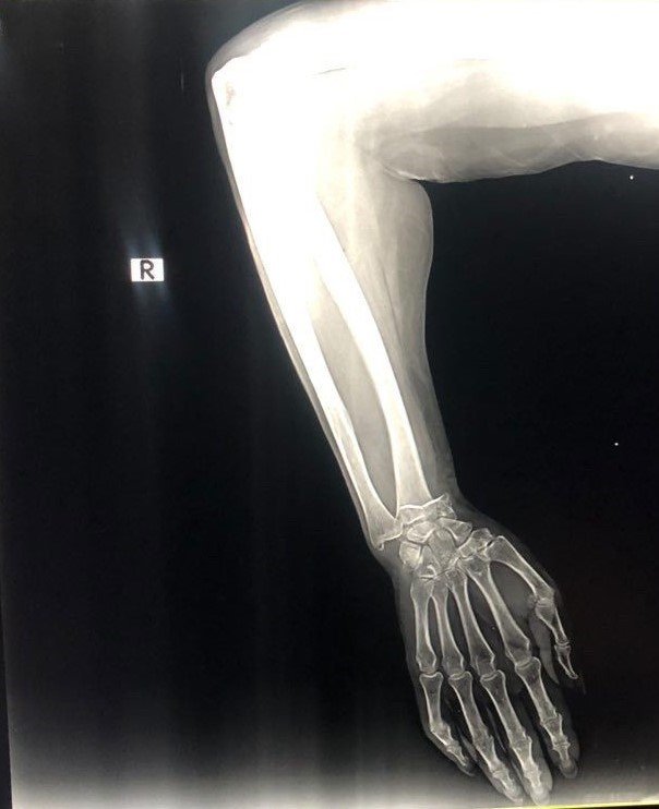 Bileği kırılan Ukraynalı kadından 44 bin 555 TL’lik alçı faturası itirazı