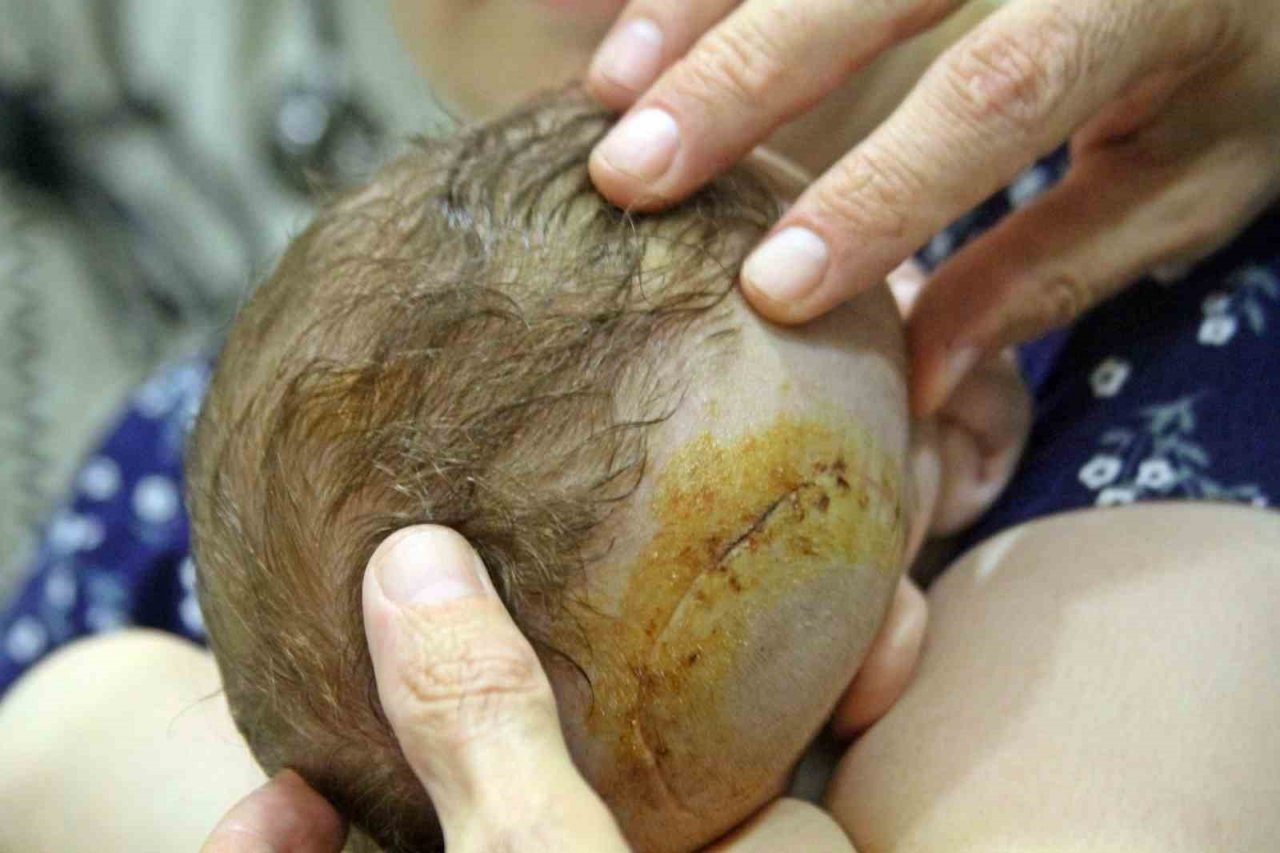 Pusetten düşüp kafatası kırılan 1 aylık bebek, başarılı ameliyatla hayata tutundu