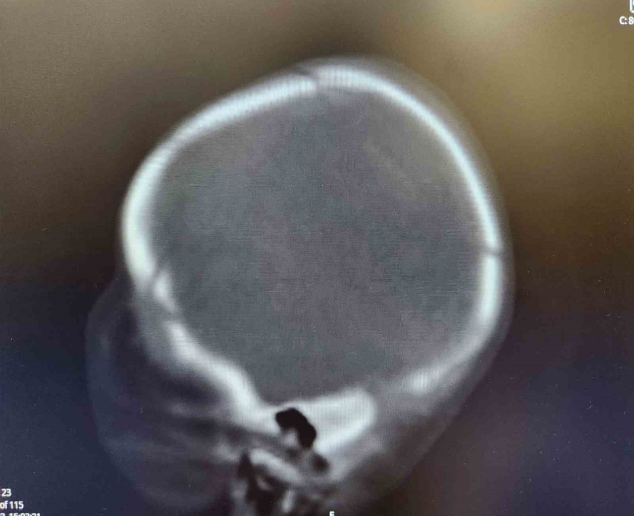 Pusetten düşüp kafatası kırılan 1 aylık bebek, başarılı ameliyatla hayata tutundu